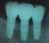 Three implants and three implant crowns