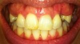 Three implants and three implant crowns