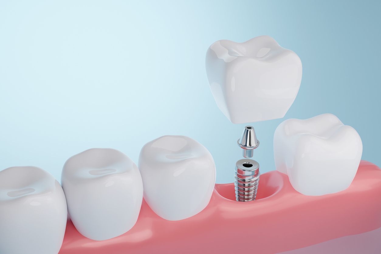 Dr. Albina Veys Dental Implants