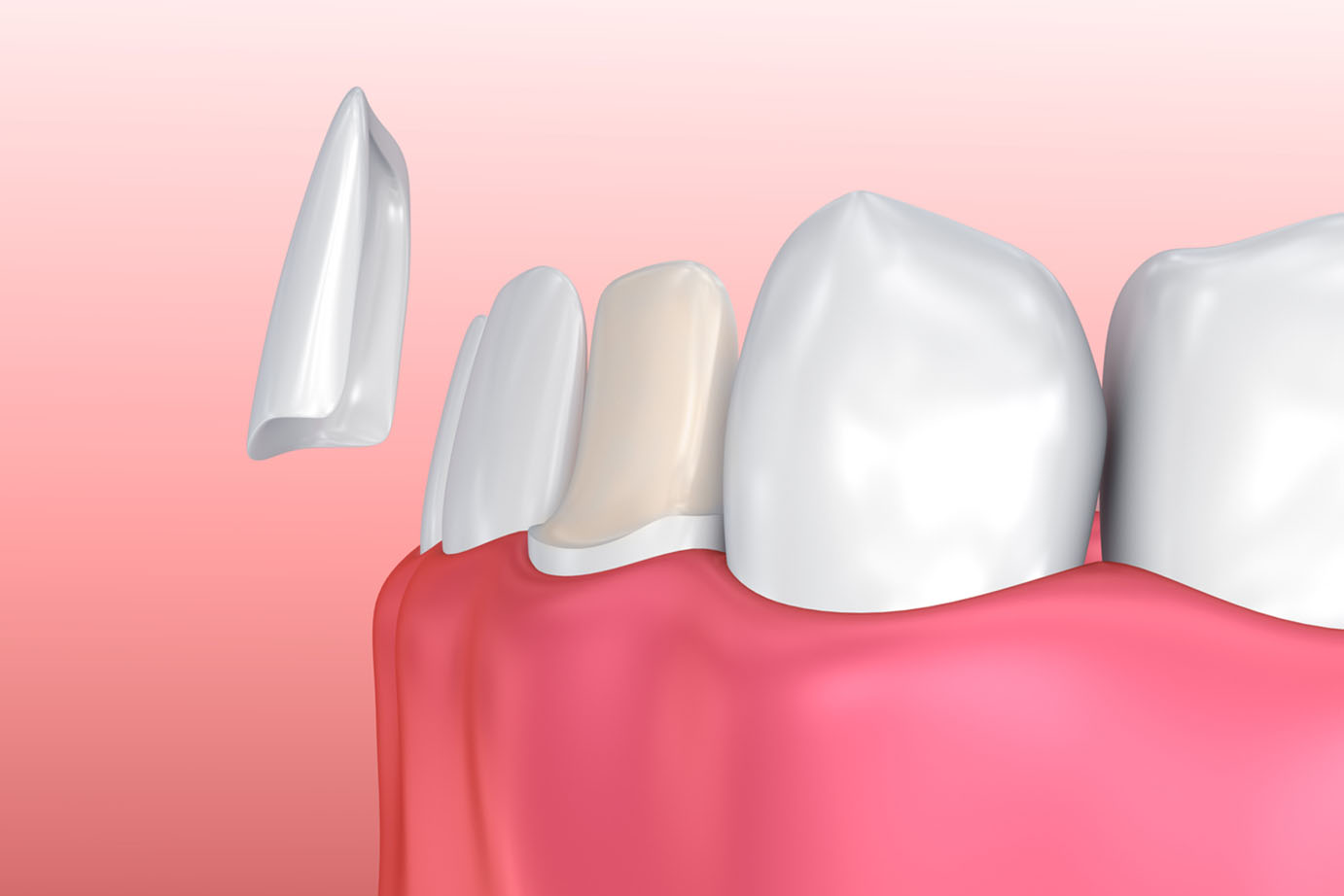 Dental Porcelain Veneers Installation Procedure Collegeville