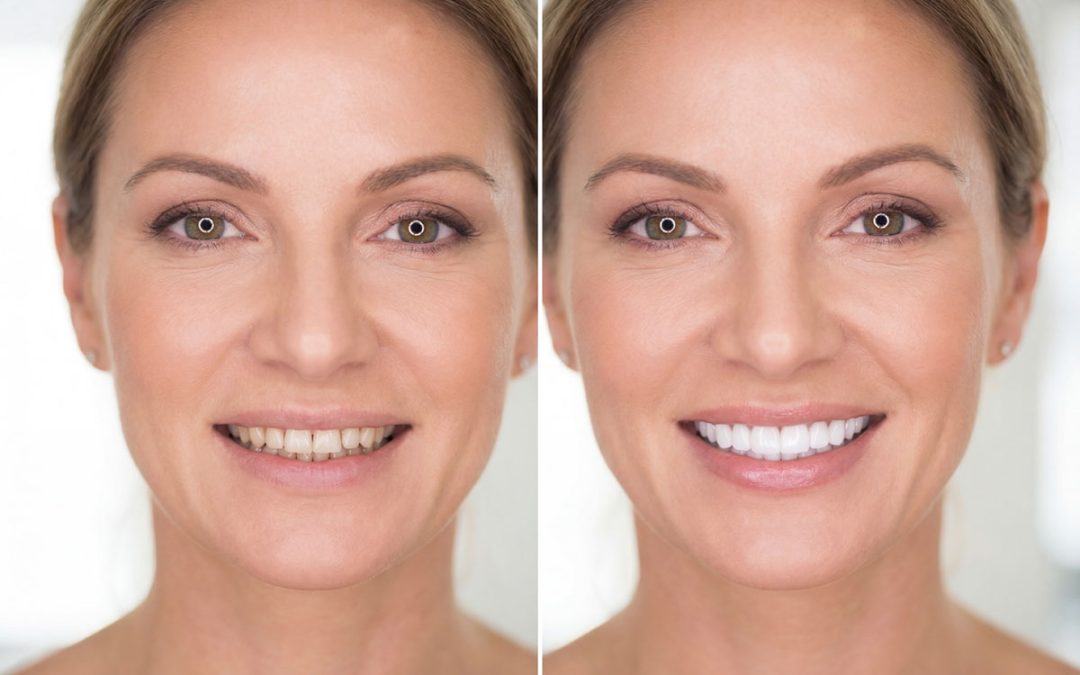Albina Veys DMD professional cosmetic dental veneers and teeth whitening services in Collegeville PA