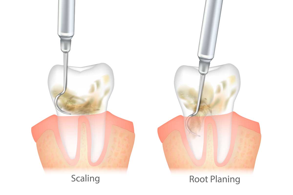 Dr. Albina Veys DMD Collegeville PA Dental Scaling and Root Planing Services