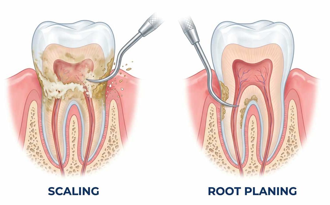 Albina Veys DMD dental scaling and root planing services in Collegeville PA